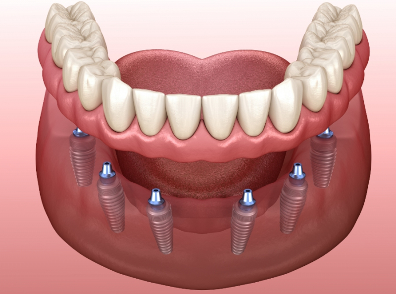 Имплантация всего зубного ряда по системе All-on-4или All-on-6 Олис Смайл Калуга